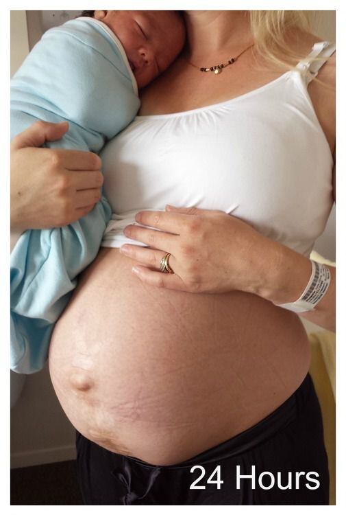 Viral: el mensaje de una madre sobre la realidad de la cesárea